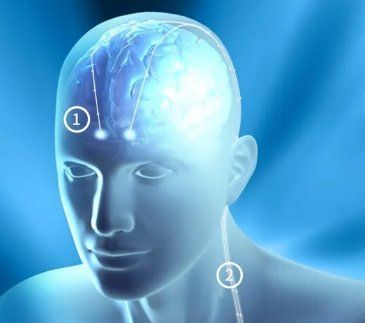 人工刺激療法成功率高嗎，人工刺激療法成功率高度依賴適應(yīng)癥、患者群體與治療參數(shù)