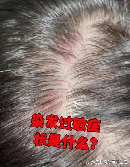 紅龍染發(fā)劑有哪些副作用，紅龍染發(fā)劑中的化學(xué)物質(zhì)可能導(dǎo)致頭發(fā)瘙癢、紅腫等癥狀