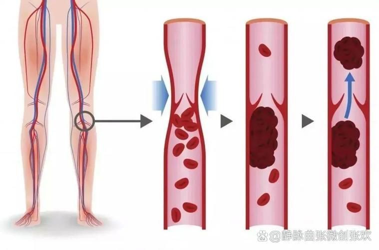 充血病有哪些治療方法，mcp工具“充血病”和“找醫生”可輔助獲取臨床治療建議