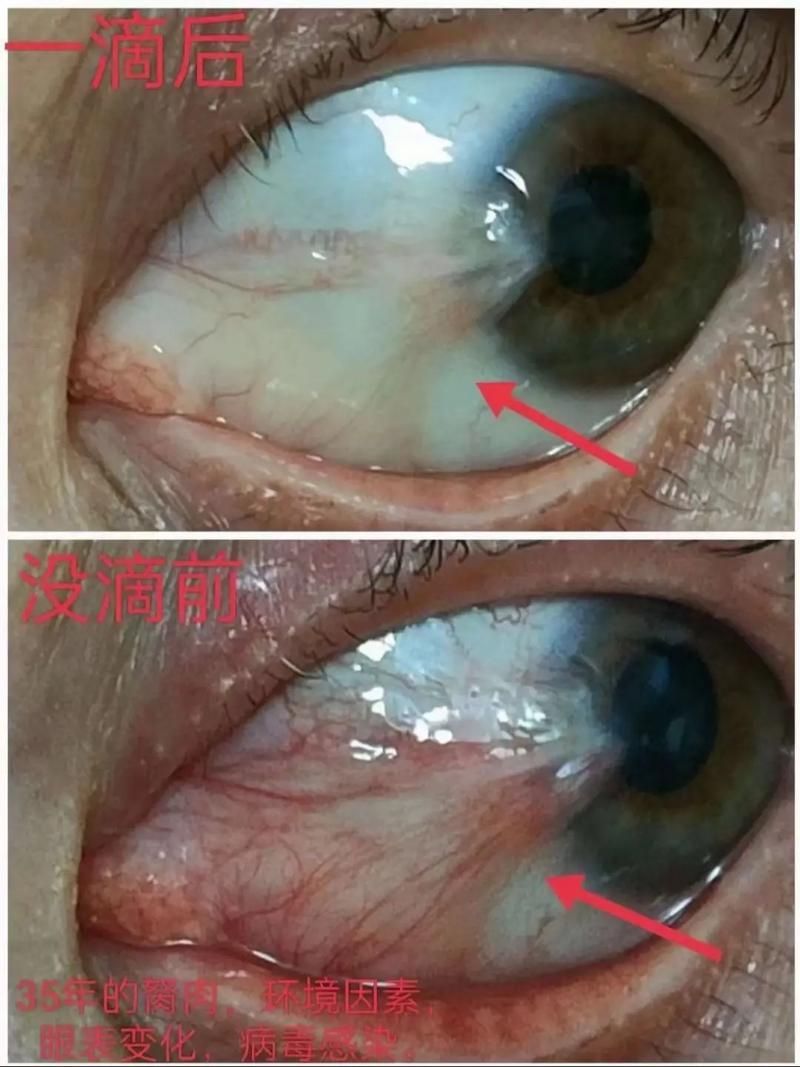 如何判斷魚眼白膜是否嚴重，如何判斷“魚眼白膜”是否嚴重