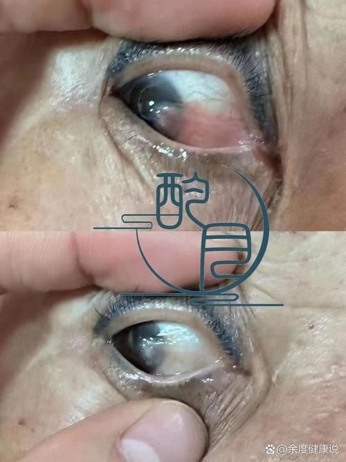 如何判斷魚眼白膜是否嚴重，如何判斷“魚眼白膜”是否嚴重