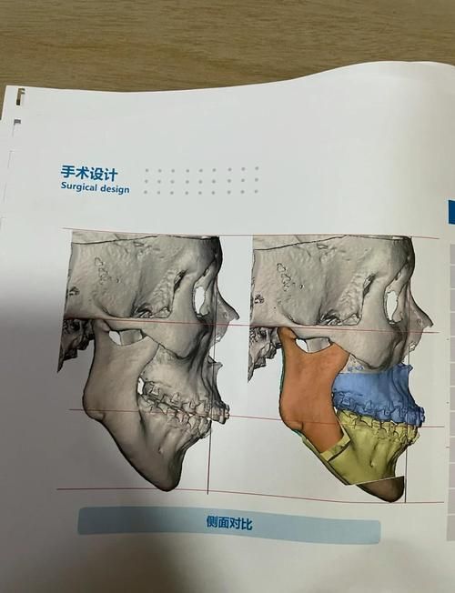 有哪些成功的龍魚咬嘴正骨手術案例，“龍魚咬嘴正骨手術”是否存在的觀賞魚醫療操作