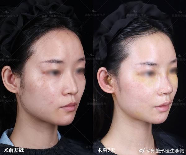 有哪些成功的龍魚咬嘴正骨手術案例，“龍魚咬嘴正骨手術”是否存在的觀賞魚醫療操作