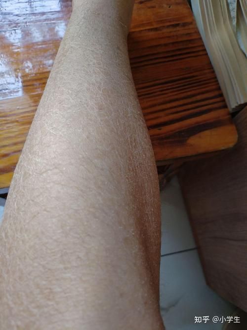 給我一些早期發現魚炸鱗病的圖片，早期發現魚炸鱗病如何治療