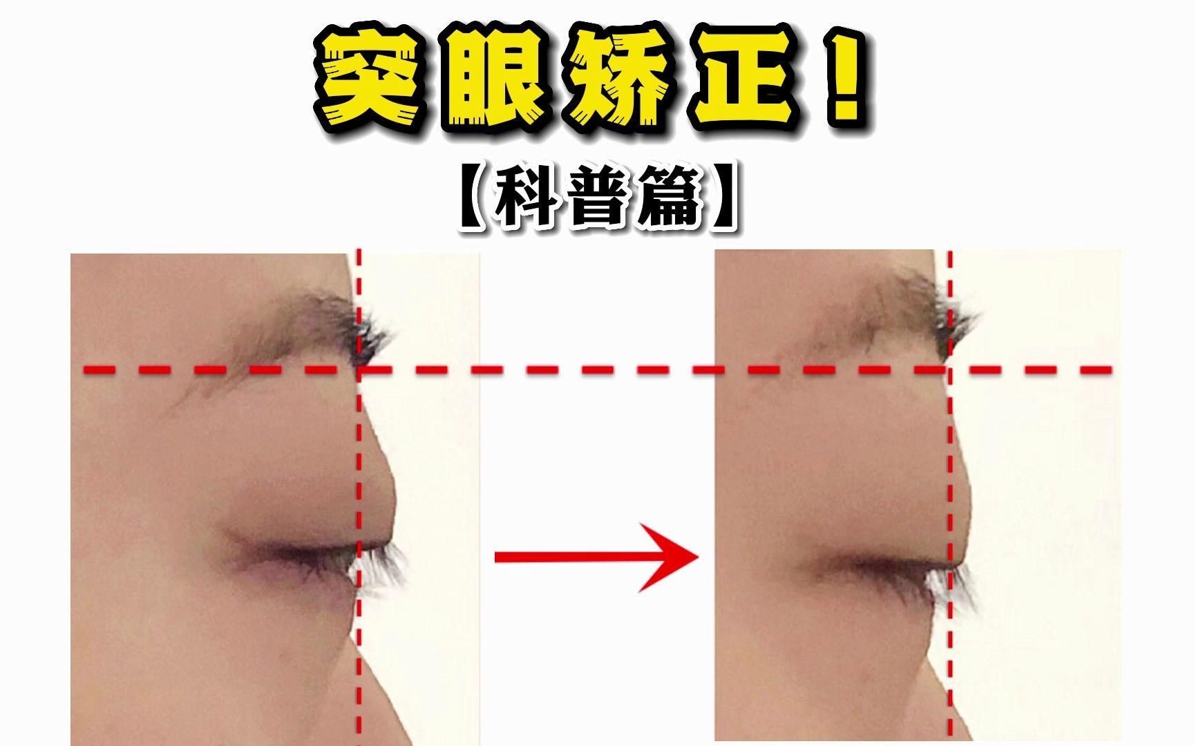 給我一些治療魚突眼的偏方（人類），魚突眼偏方中哪個最有效 給我一些治療魚突眼的偏方（人類），魚突眼偏方中哪個最有效 龍魚百科 第2張