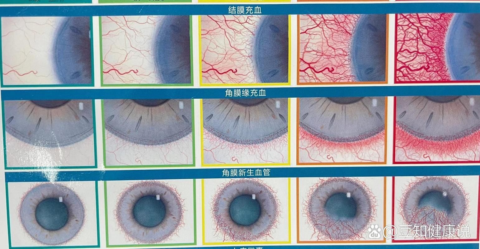 如何區分輕度、中度和重度充血，權威醫學圖譜類圖像與充血（congestion）的區分詳解