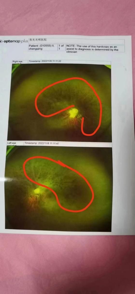 如何判斷蒙眼病的嚴重程度，“蒙眼病”在醫(yī)學上主要對應“夜盲癥”