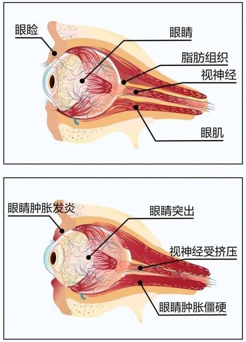蒙眼和凸眼哪個更嚴重