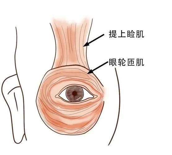 蒙眼和凸眼哪個更嚴重