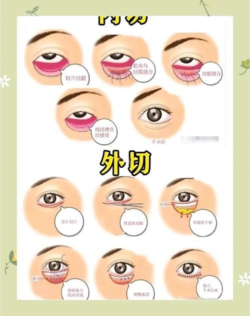 蒙眼和凸眼哪個更嚴重