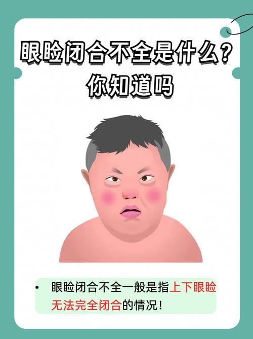 蒙眼和凸眼哪個更嚴重