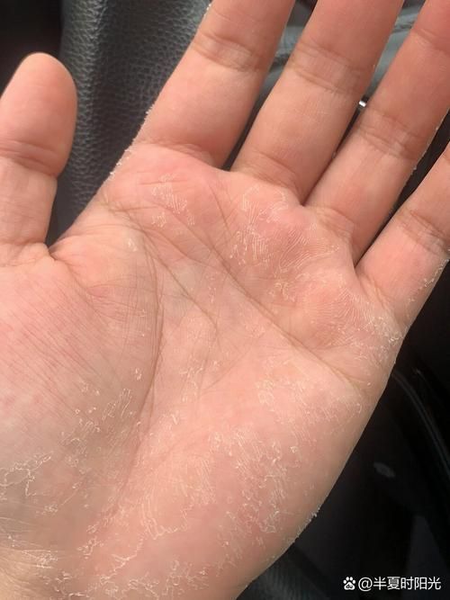 能否提供更多真菌和細(xì)菌感染的典型圖片，真菌與細(xì)菌感染對(duì)比圖鑒，紅龍魚的眼質(zhì)問題如何判斷