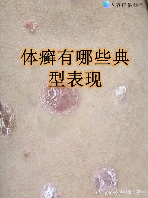 能否提供更多真菌和細(xì)菌感染的典型圖片，真菌與細(xì)菌感染對(duì)比圖鑒，紅龍魚的眼質(zhì)問題如何判斷