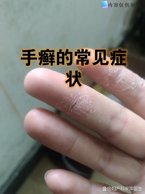 能否提供更多真菌和細(xì)菌感染的典型圖片，真菌與細(xì)菌感染對(duì)比圖鑒，紅龍魚的眼質(zhì)問題如何判斷