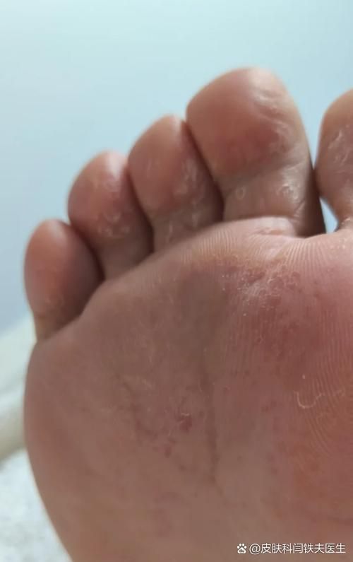 能否提供更多真菌和細(xì)菌感染的典型圖片，真菌與細(xì)菌感染對(duì)比圖鑒，紅龍魚的眼質(zhì)問題如何判斷