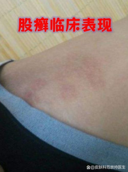 能否提供更多真菌和細(xì)菌感染的典型圖片，真菌與細(xì)菌感染對(duì)比圖鑒，紅龍魚的眼質(zhì)問題如何判斷