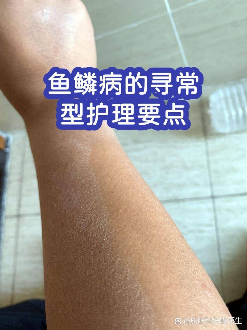 魚鱗病患者如何進行日常護理，魚鱗病患者日常護理 魚鱗病患者如何進行日常護理，魚鱗病患者日常護理 龍魚百科 第1張