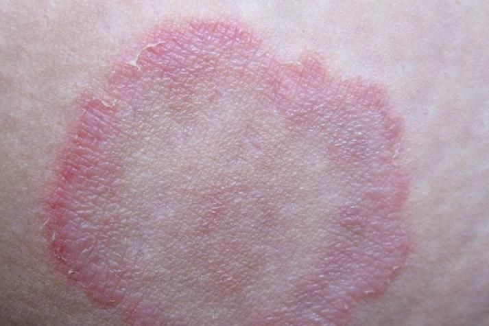 真菌和細菌感染的治療方法有哪些，真菌與細菌感染的區(qū)別 真菌和細菌感染的治療方法有哪些，真菌與細菌感染的區(qū)別 龍魚百科 第3張