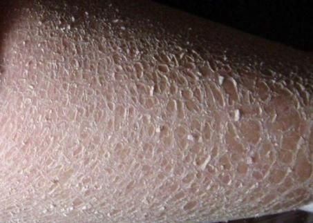 如何預(yù)防立鱗病的傳染，關(guān)于錦鯉立鱗病