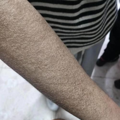 如何預(yù)防立鱗病的傳染，關(guān)于錦鯉立鱗病