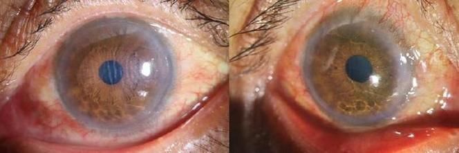 如何預防魚兒蒙眼病復發，如何防治魚兒蒙眼病