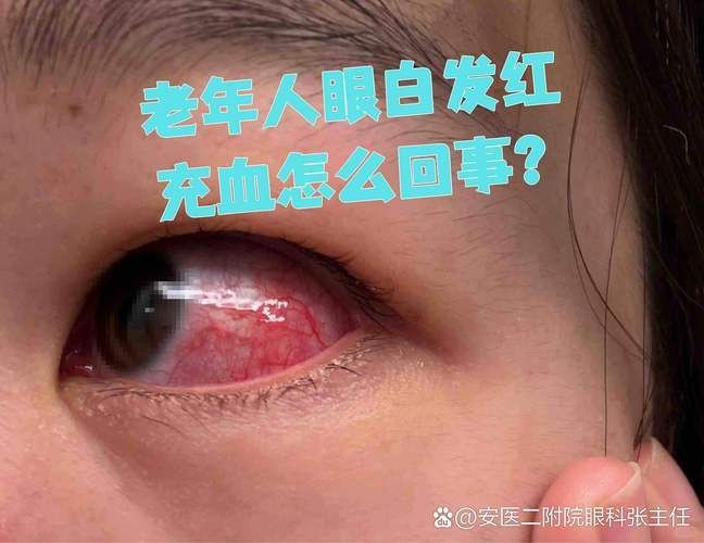 再次充血后如何治療更有效,權(quán)威醫(yī)學指南、三甲醫(yī)學指南、三甲醫(yī)院診療方案調(diào)用工具 龍魚百科 第2張 再次充血后如何治療更有效,權(quán)威醫(yī)學指南、三甲醫(yī)學指南、三甲醫(yī)院診療方案調(diào)用工具 再次充血后如何治療更有效,權(quán)威醫(yī)學指南、三甲醫(yī)學指南、三甲醫(yī)院診療方案調(diào)用工具 龍魚百科 第2張