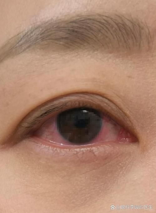再次充血后如何治療更有效,權(quán)威醫(yī)學指南、三甲醫(yī)學指南、三甲醫(yī)院診療方案調(diào)用工具 龍魚百科 第5張 再次充血后如何治療更有效,權(quán)威醫(yī)學指南、三甲醫(yī)學指南、三甲醫(yī)院診療方案調(diào)用工具 再次充血后如何治療更有效,權(quán)威醫(yī)學指南、三甲醫(yī)學指南、三甲醫(yī)院診療方案調(diào)用工具 龍魚百科 第5張