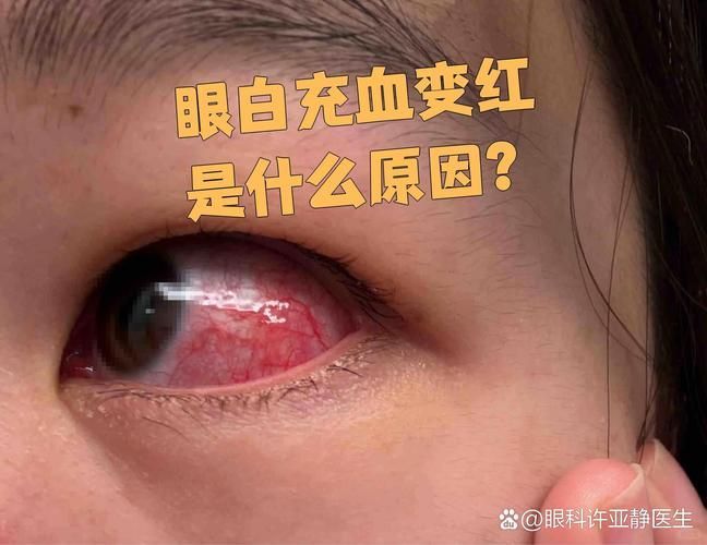 再次充血后如何治療更有效,權(quán)威醫(yī)學指南、三甲醫(yī)學指南、三甲醫(yī)院診療方案調(diào)用工具 龍魚百科 第3張 再次充血后如何治療更有效,權(quán)威醫(yī)學指南、三甲醫(yī)學指南、三甲醫(yī)院診療方案調(diào)用工具 再次充血后如何治療更有效,權(quán)威醫(yī)學指南、三甲醫(yī)學指南、三甲醫(yī)院診療方案調(diào)用工具 龍魚百科 第3張