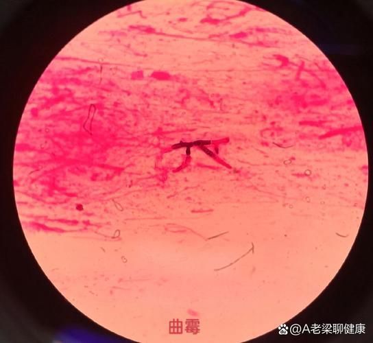 如何判斷龍魚蒙眼是否由真菌引起，%～20%20%20%20%20%20%氫氧化鉀