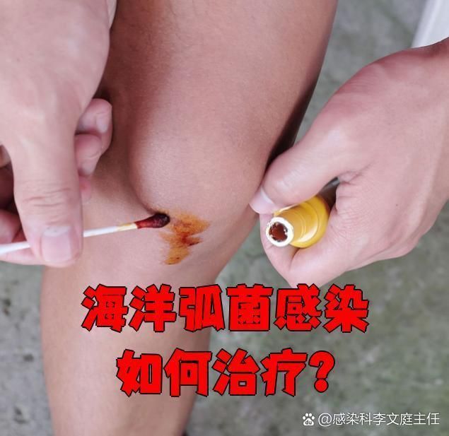 海洋創傷弧菌感染有哪些治療方法，創傷弧菌感染如何治療 海洋創傷弧菌感染有哪些治療方法，創傷弧菌感染如何治療 龍魚百科 第1張
