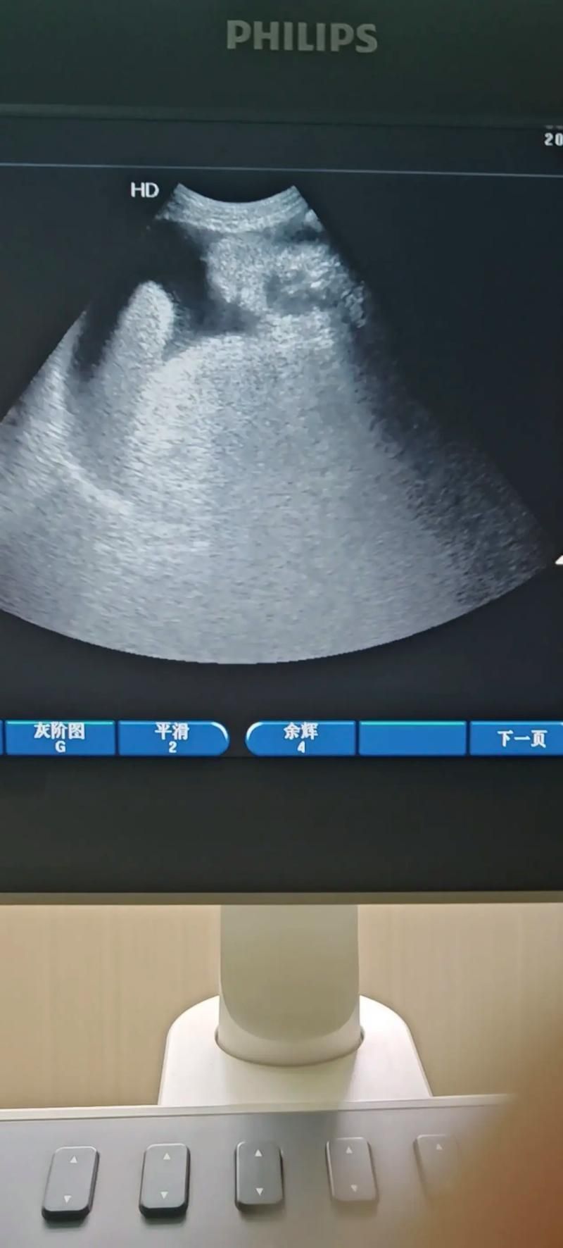 如何判斷魚腹水是否好轉，如何判斷腹水好轉