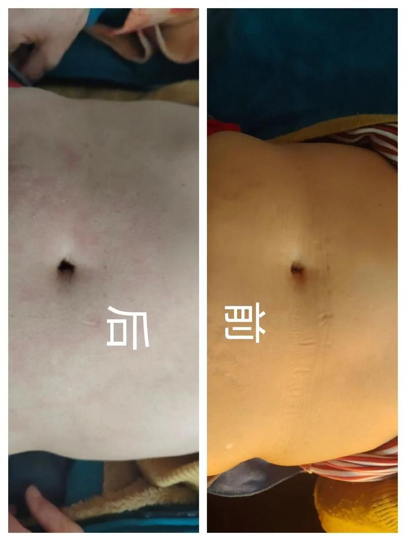 如何判斷腹水是否好轉(zhuǎn)，共調(diào)用2個(gè)工具判斷腹水是否好轉(zhuǎn) 如何判斷腹水是否好轉(zhuǎn)，共調(diào)用2個(gè)工具判斷腹水是否好轉(zhuǎn) 龍魚百科 第5張
