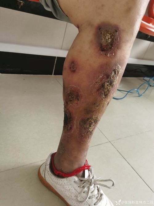 能提供更多潰爛病的圖片嗎,常見潰爛病的癥狀對比表 龍魚百科 第7張 能提供更多潰爛病的圖片嗎,常見潰爛病的癥狀對比表 能提供更多潰爛病的圖片嗎,常見潰爛病的癥狀對比表 龍魚百科 第7張