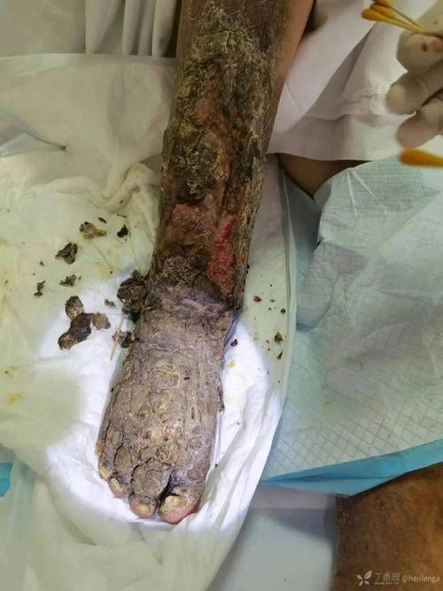 能提供更多潰爛病的圖片嗎，常見潰爛病的癥狀對比表 能提供更多潰爛病的圖片嗎，常見潰爛病的癥狀對比表 龍魚百科 第14張