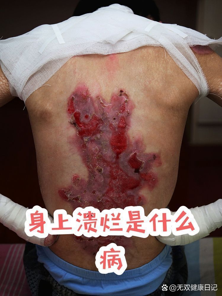 爛身病有哪些癥狀，爛身病，也被稱為皮膚感染或皮膚疾病，是一種常見的健康問題 爛身病有哪些癥狀，爛身病，也被稱為皮膚感染或皮膚疾病，是一種常見的健康問題 龍魚百科 第2張