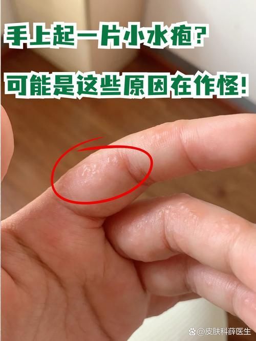 有哪些手部真菌感染的常見誤區，手部真菌感染（手上長癬）的常見誤區