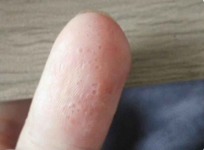 有哪些手部真菌感染的常見誤區，手部真菌感染（手上長癬）的常見誤區