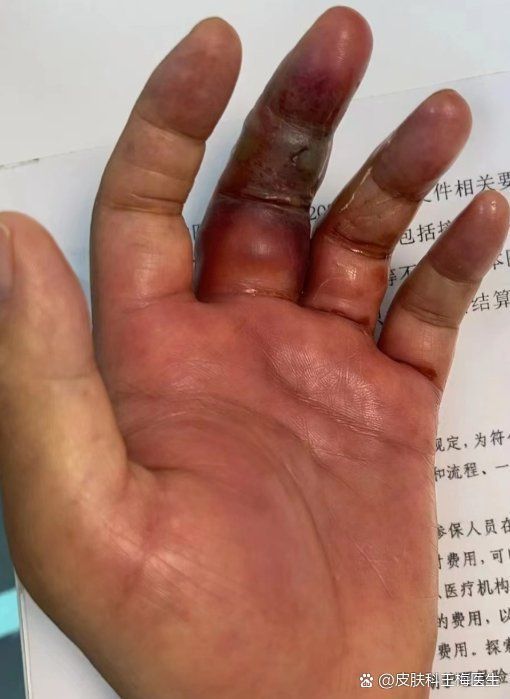 感染海水細菌后如何治療，中的“海水細菌”→創傷弧菌