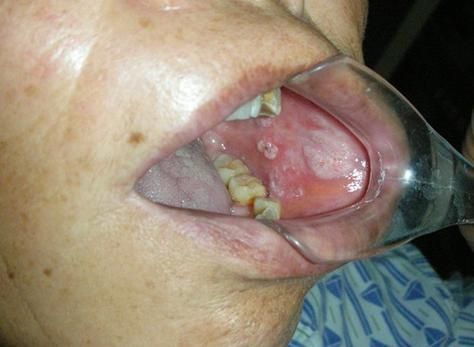 如何區分龍魚嘴巴的良性與惡性腫瘤？，如何區分龍魚嘴巴的良性與惡性腫瘤并明確要求1000字說明和配圖 如何區分龍魚嘴巴的良性與惡性腫瘤？，如何區分龍魚嘴巴的良性與惡性腫瘤并明確要求1000字說明和配圖 龍魚百科 第4張