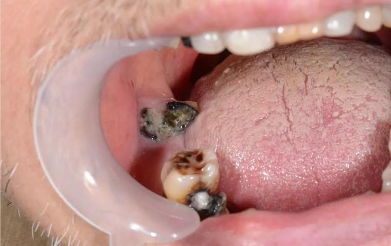 如何區分龍魚嘴巴的良性與惡性腫瘤？，如何區分龍魚嘴巴的良性與惡性腫瘤并明確要求1000字說明和配圖 如何區分龍魚嘴巴的良性與惡性腫瘤？，如何區分龍魚嘴巴的良性與惡性腫瘤并明確要求1000字說明和配圖 龍魚百科 第6張
