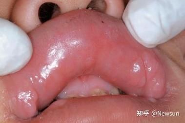 如何區分龍魚嘴巴的良性與惡性腫瘤？，如何區分龍魚嘴巴的良性與惡性腫瘤并明確要求1000字說明和配圖 如何區分龍魚嘴巴的良性與惡性腫瘤？，如何區分龍魚嘴巴的良性與惡性腫瘤并明確要求1000字說明和配圖 龍魚百科 第2張