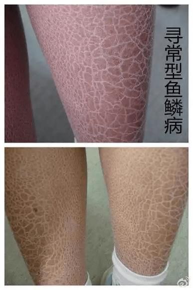 能否提供更多關于魚鱗病的圖片，如何鑒別魚鱗病 能否提供更多關于魚鱗病的圖片，如何鑒別魚鱗病 龍魚百科 第4張