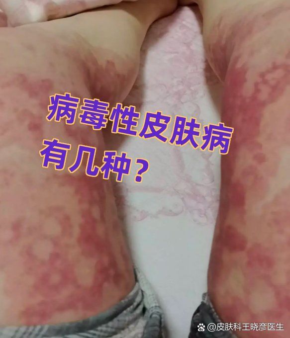 病毒性爛身病如何防控，如何防控病毒性爛身病 病毒性爛身病如何防控，如何防控病毒性爛身病 龍魚百科 第2張
