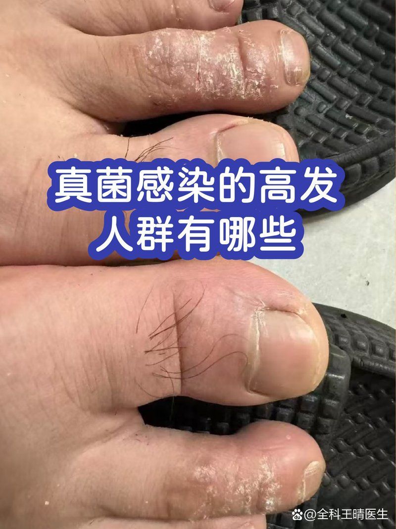 哪些人群更容易患真菌感染，哪些人容易患真菌感染？ 哪些人群更容易患真菌感染，哪些人容易患真菌感染？ 龍魚百科 第2張