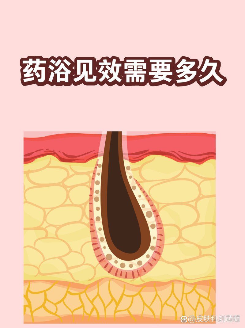 藥浴治療一般需要多長時間見效，藥浴治療期間需要多長時間見效，藥浴見效時間因人而異
