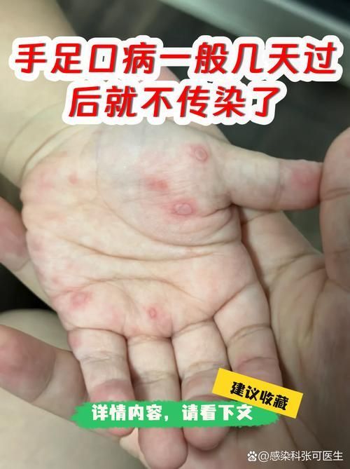 交叉感染后如何護(hù)理，交叉感染后如何護(hù)理思考完成共調(diào)用2個工具 交叉感染后如何護(hù)理，交叉感染后如何護(hù)理思考完成共調(diào)用2個工具 龍魚百科 第5張