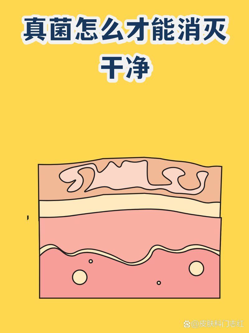 有哪些有效的真菌治療方法，皮膚真菌感染怎么辦 有哪些有效的真菌治療方法，皮膚真菌感染怎么辦 龍魚百科 第2張