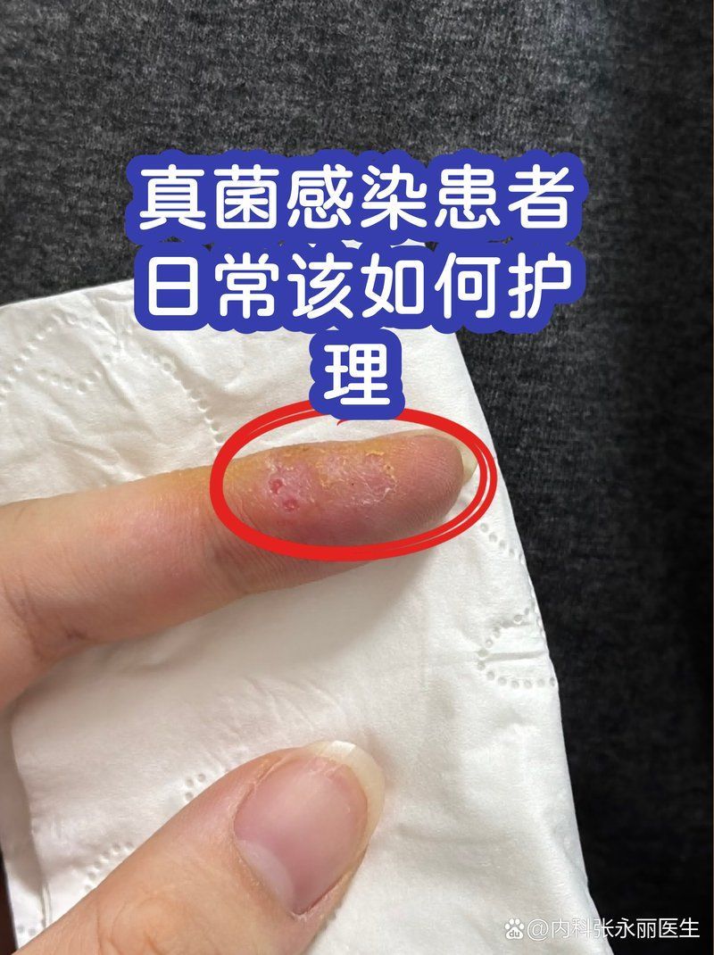 晚期真菌感染如何預防復發，晚期真菌感染的預防復發