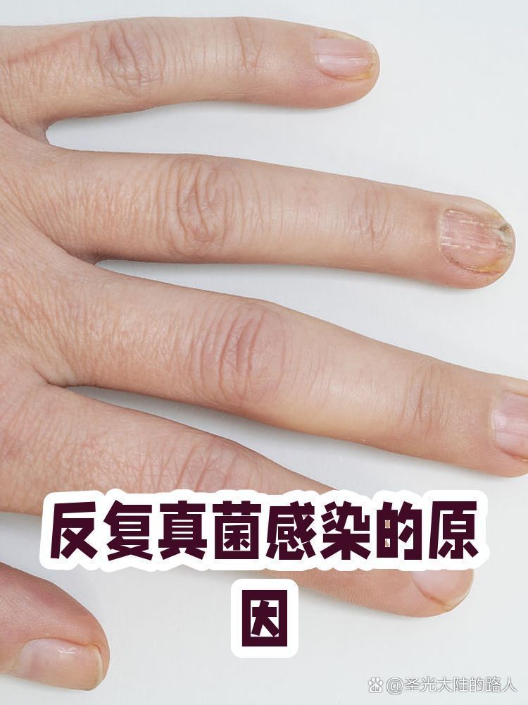 詳細閱讀:晚期真菌感染如何預防復發(fā),晚期真菌感染的預防復發(fā) 晚期真菌感染如何預防復發(fā),晚期真菌感染的預防復發(fā)