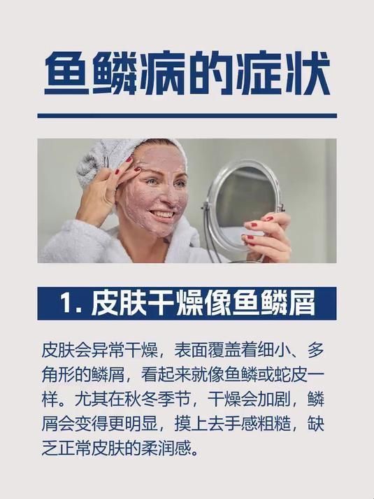 魚鱗病的癥狀有哪些，魚鱗病的主要癥狀有哪些